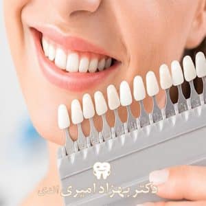 لمینت دندان در مازندران