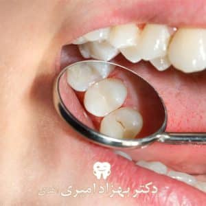 درمان ریشه دندان در بابل