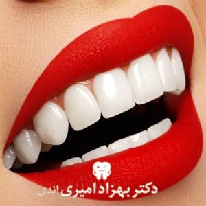 لمینت یا ونیر دندان