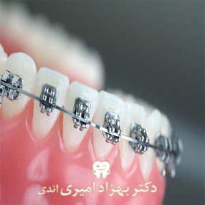 مدت زمان و طول درمان ارتودنسی