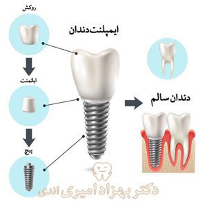 ایمپلنت دندان