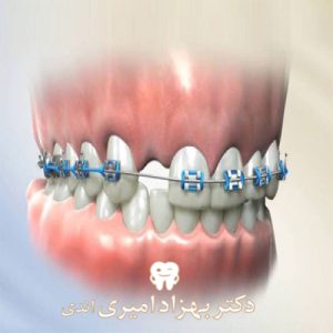 ارتودنسی قبل از انجام ایمپلنت یا بعد از آن؟