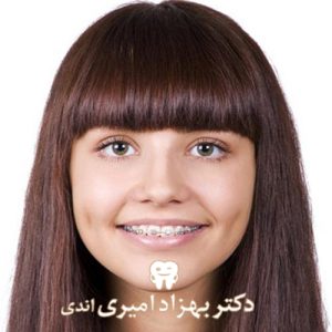 مدت زمان و طول درمان ارتودنسی