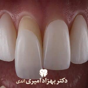 لمینت یا ونیر دندان