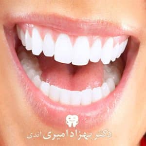 اصلاح طرح لبخند