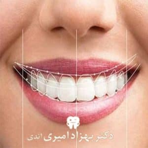 اصلاح طرح لبخند