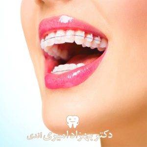 ارتودنسی قبل از انجام ایمپلنت یا بعد از آن؟