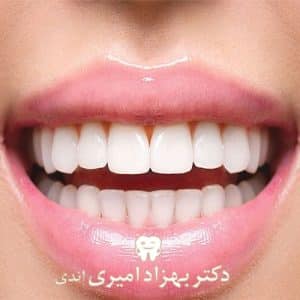 اصلاح طرح لبخند