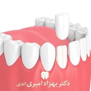 روکش های زیبایی دندان
