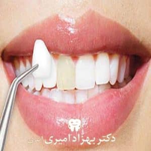 کامپوزیت و باندینگ