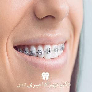 بهترین سن برای شروع درمان ارتودنسی