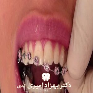 عوارض و مشکلات ارتودنسی دندان ها و درمانهای اورژانسی