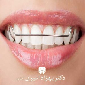 پلاک و نگهدارنده حین و بعد از ارتودنسی