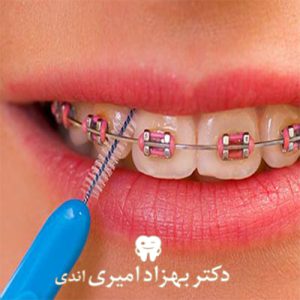 مراقبت‌های حین و بعد از ارتودنسی