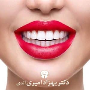 لمینت یا ونیر دندان