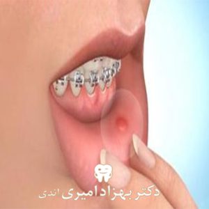 عوارض و مشکلات ارتودنسی دندان ها و درمانهای اورژانسی