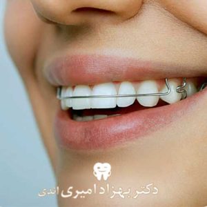 ردیف و صاف کردن دندان‌