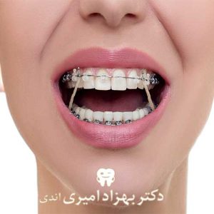 ردیف و صاف کردن دندان‌