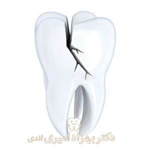 شکستگی و ترک دندان