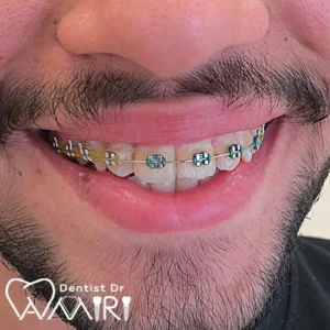 ارتودنسی ثابت در بابل | هزینه ارتودنسی در مازندران ۱۴۰۴