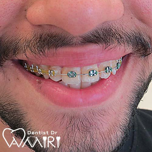 ارتودنسی ثابت در بابل | هزینه ارتودنسی در مازندران ۱۴۰۴