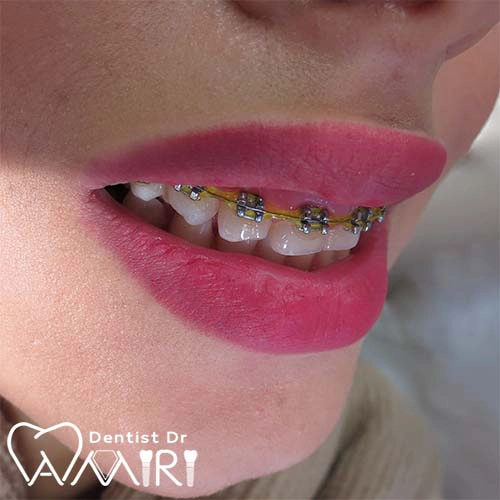 ارتودنسی در بابل _ براکت فلزی