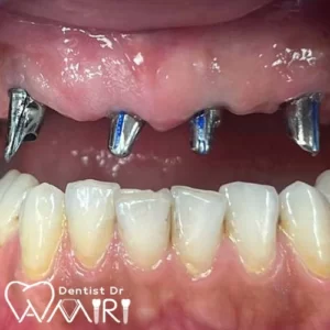 ایمپلنت فوری در بابل و مازندران – راهنمای کامل ایمپلنت فوری در بابل و مازندران – راهنمای کامل