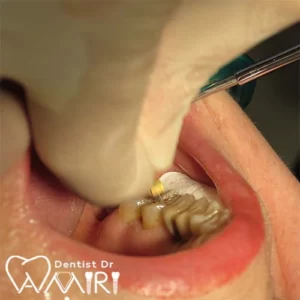 درمان ریشه در بابل