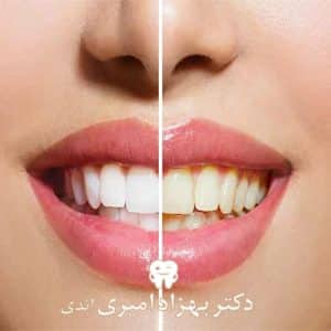 قبل و بعد کامپوزیت دندان