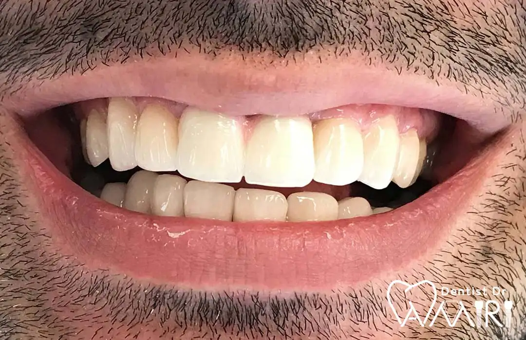 نتیجه نهایی لمینت دندان همراه با روکش دو دندان جلو پس از درمان