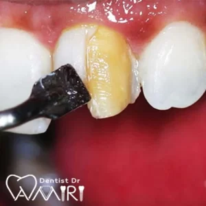 مراحل کامپوزیت دندان در بابل