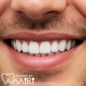 اصلاح طرح لبخند با کامپوزیت دندان در بابل