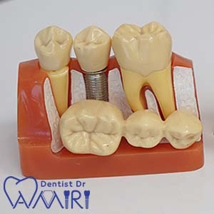 ایمپلنت دندان