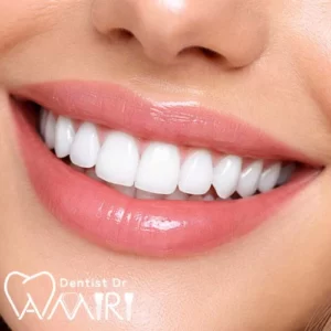 لمینت دندان