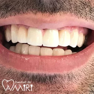 لمینت دندان در بابل