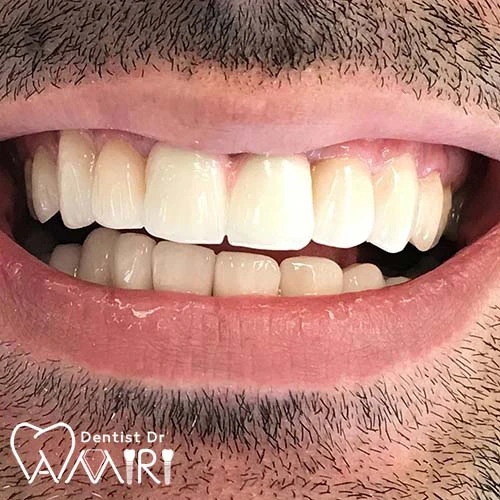 لمینت دندان در بابل