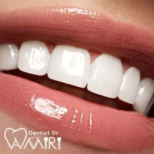 لبخند دندان لمینت شده