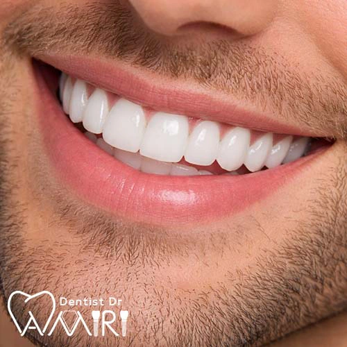 لمینت کامل دندان در بابل