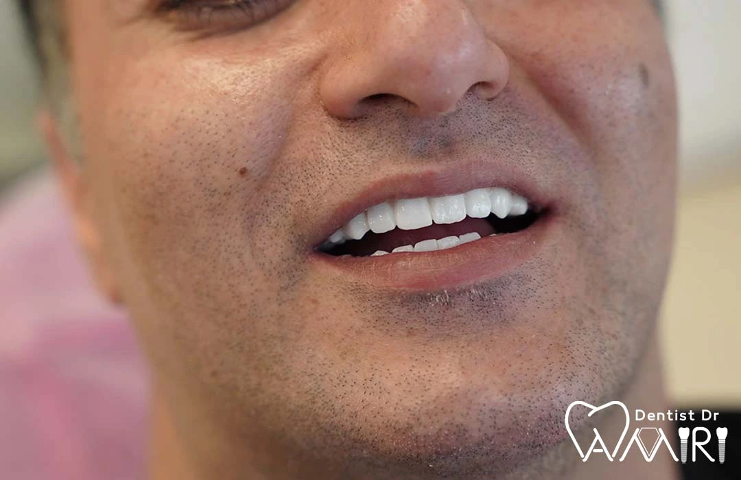 نتیجه کاشت ایمپلنت فول ماوس توسط دکتر بهزاد امیری در بابل