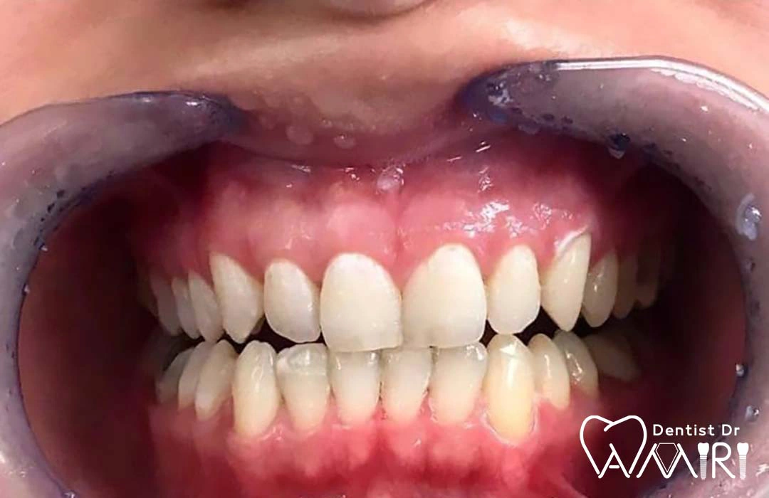 دندان ها بعد از بلیچینگ توسط دکتر بهزاد امیری اندی در بابل