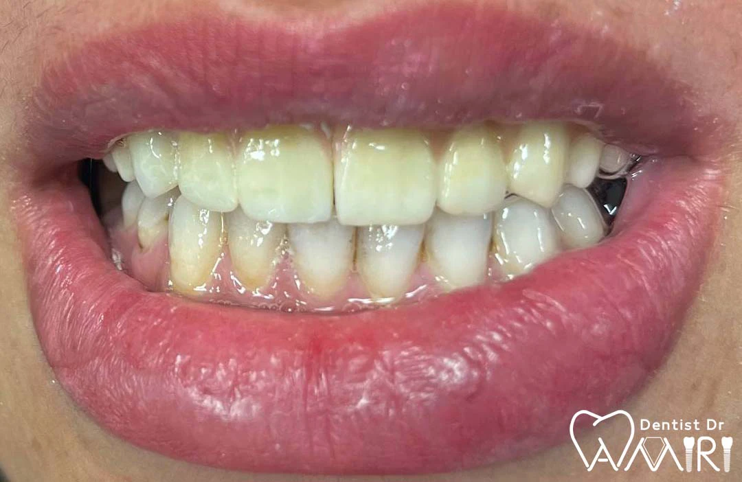 ایمپلنت فک بالا توسط دکتر بهزاد امیری اندی