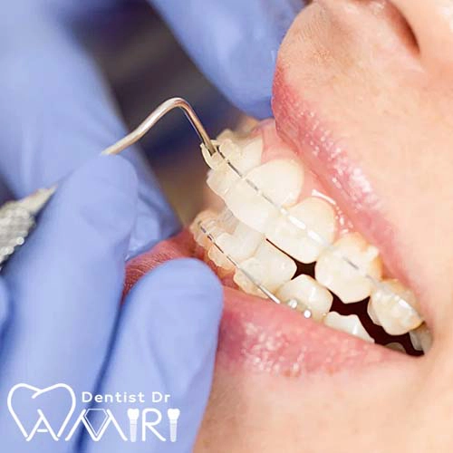 ارتودنسی سرامیکی در بابل