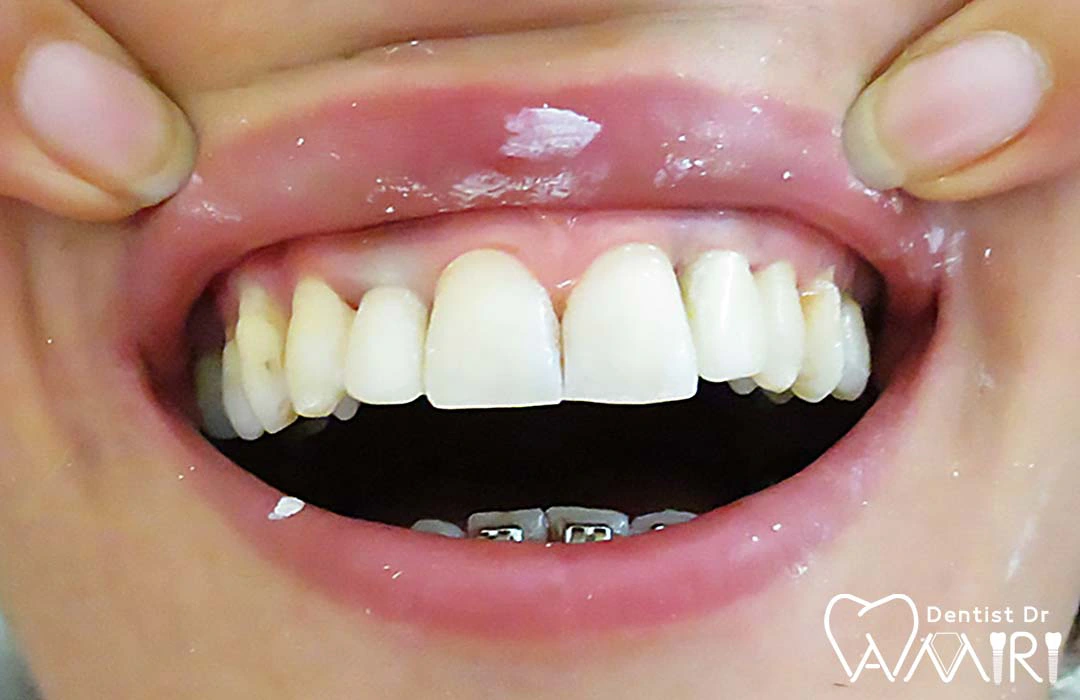 ایمپلنت دندان جلو