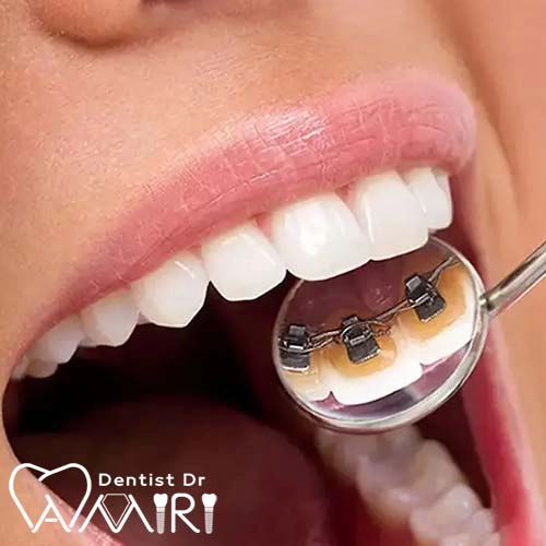 ارتودنسی لینگوال در بابل