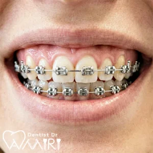ارتودنسی در بابل و اصلاح لبخند با براکت