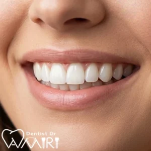 انواع لمینت دندان سرامیکی و ایمکس برای اصلاح طرح لبخند