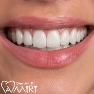 اصلاح طرح لبخند با لمینت دندان در بابل - کلینیک تخصصی دکتر بهزاد امیری